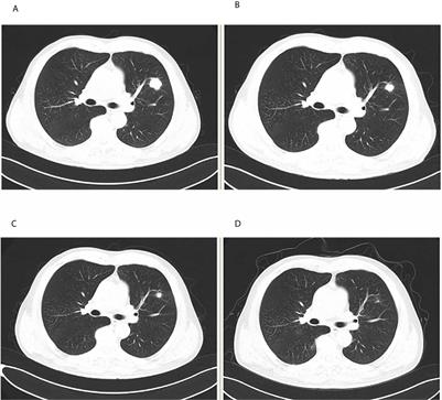 Case Report: THSD7A-Positive Membranous Nephropathy Caused by Tislelizumab in a Lung Cancer Patient